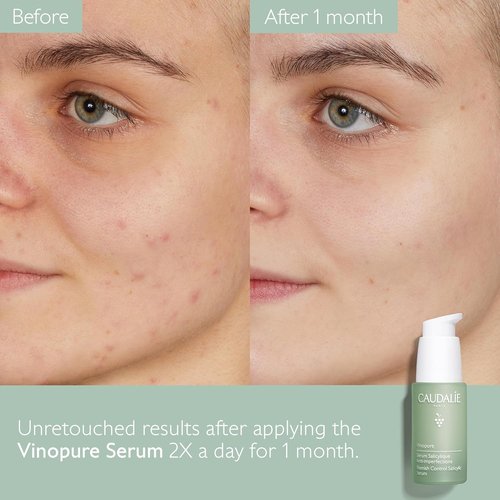Caudalie Vinopure Acne Treatment Trio - Skin Perfecting Serum 30 mL | Purifying Gel Cleanser 75 mL | Salicylic Spot Solution 15 mL