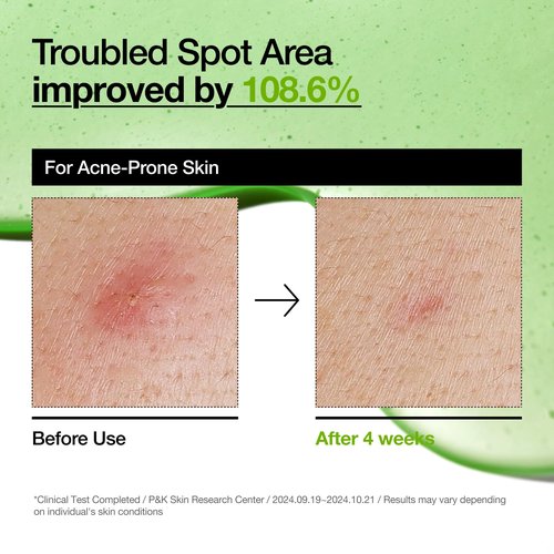 Anua Azelaic Acid 10 Hyaluron Redness Soothing Serum, Facial Serum for Blemish-Prone & Sensitive Skin, Lightweight & Hydrating Blemish Care, Hyaluronic Acid, Korean Skincare, 1.01 fl oz.