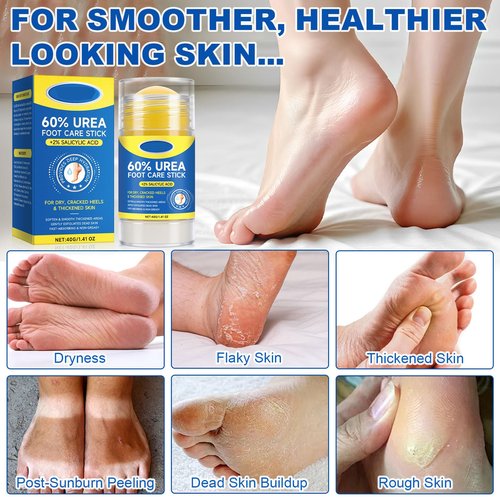 60% Urea Foot Cream Stick with 2% Salicylic Acid, Extra-Strength Cracked Heel Repair for Dry Feet & Calluses, Moisturizing Urea Cream Stick for Dead Skin Removal, Heel Balm for Rough Skin(2pcs)