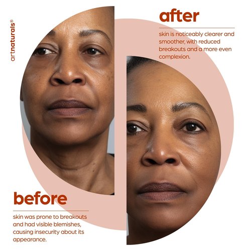 artnaturals Salicylic acid Serum - Advanced Serum with 2% BHA - Helps control oil production- Pore Reducer - 1 oz