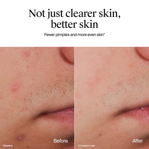 Neutrogena Oil-Free Acne Face Wash, Fragrance Free, Sensitive Skin Facial Cleanser with 2% Salicylic Acid Acne Treatment for Face, 9.1 Fl Oz