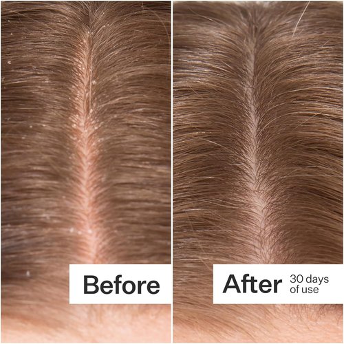 ACT+ ACRE Microbiome Cooling Scalp Serum - Instant Relief for Dry, Itchy Scalp - 2.2 fl oz, Vegan & Paraben-Free