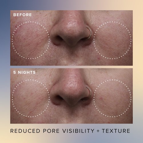 Farmacy Face Exfoliator Serum - Honey Glow 17% AHA + BHA Liquid Exfoliant & Salicylic Acid Serum - Resurfacing Skin Care for Reduced Pores + Texture - Hydrates Skin for an Overall Glow (30ml)