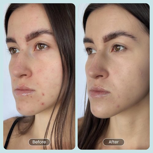 30 Day Miracle BHA 20% Peeling Solution - Clinical Strength Exfoliant for Clogged Pores & Wrinkles - 1oz Salicylic Acid Serum