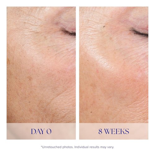 iS CLINICAL Active Peel System - Gentle Two-Step At-Home Face Exfoliation Treatment