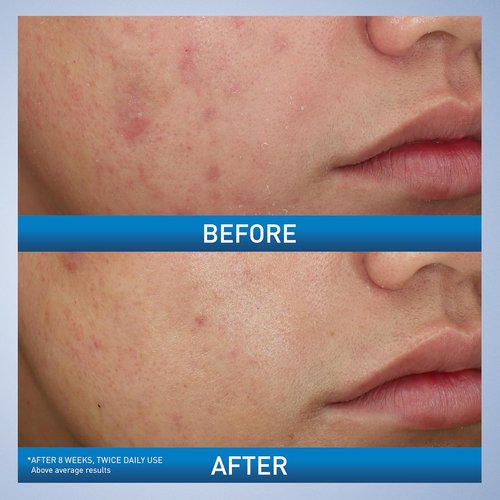 CeraVe Acne Foaming Cream Wash - Gentle Face & Body Cleanser with 10% Benzoyl Peroxide | 5 Oz