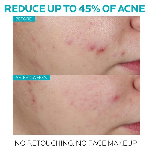 La Roche-Posay Effaclar Acne Serum - 1.5% Salicylic Acid Treatment with Glycolic Acid & Niacinamide