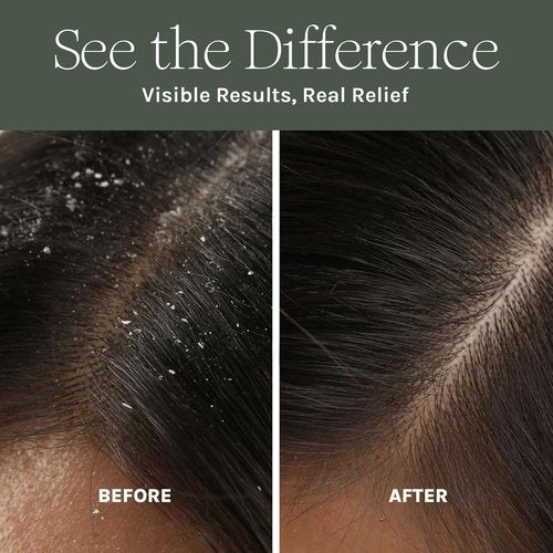 Skiennix Antifungal Scalp Mask - Natural Hair Growth Booster with Aloe & Rosemary - Detoxifying Treatment