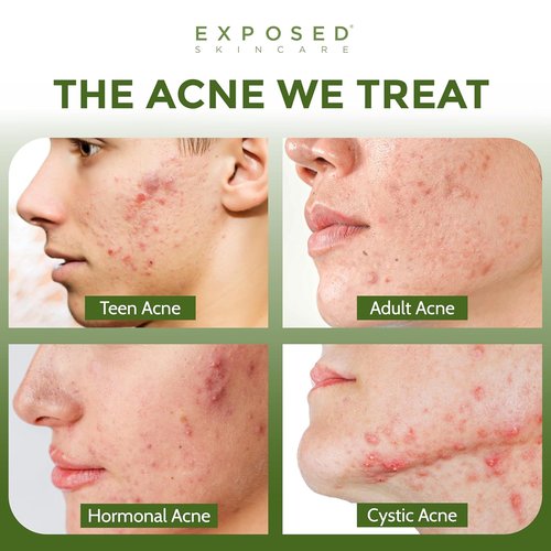 Exposed Skin Care Acne Treatment Kit - 2.5% Salicylic Acid & 3.5% Benzoyl Peroxide for Clear Skin | Natural & Cruelty-Free
