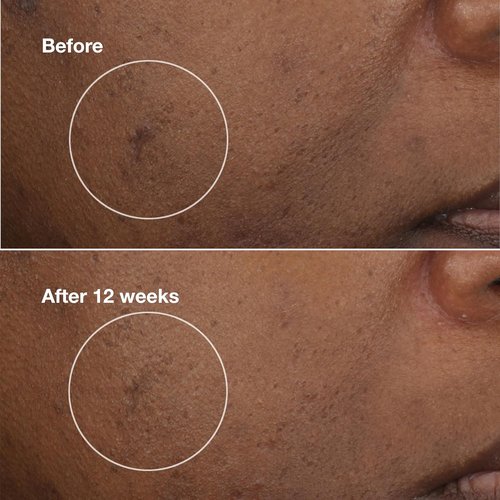 Clinique Even Better Clinical Brightening Moisturizer - Hydrating Dark Spot Reducer with Salicylic Acid & Vitamin C