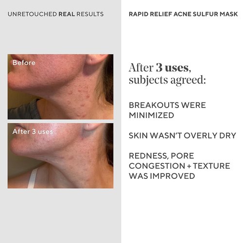 Murad Rapid Relief Acne Sulfur Mask - Clay Mask with Salicylic Acid & 5% Sulfur | Reduces Breakouts & Unclogs Pores - 2.5 Fl Oz