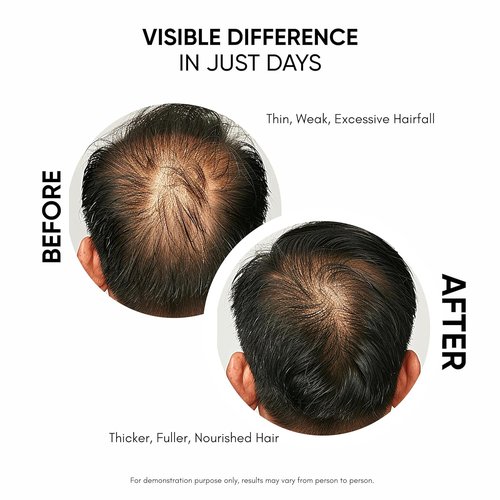 Masofta Hair Growth Serum - Promote Hair Growth & Control Hair Fall | 50ml for Men & Women