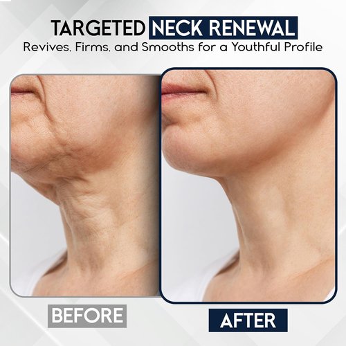 Skiennix Neck Cream - Firming & Tightening for Sagging Skin | Anti-Aging Treatment with Collagen & Hyaluronic Acid