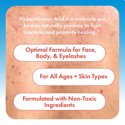 Hypochlorous Acid Spray for Face, Skin & Eyelids – pH-Balanced HOCl Facial Spray Safe for Acne, Red & Sensitive Skin – Gentle Non-Toxic Toner & Cleanser Mist for Clear, Hydrated Skin, 8 oz