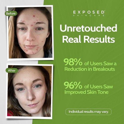 Exposed Skin Care Acne Treatment Kit - 2.5% Salicylic Acid & 3.5% Benzoyl Peroxide for Clear Skin | Natural & Cruelty-Free