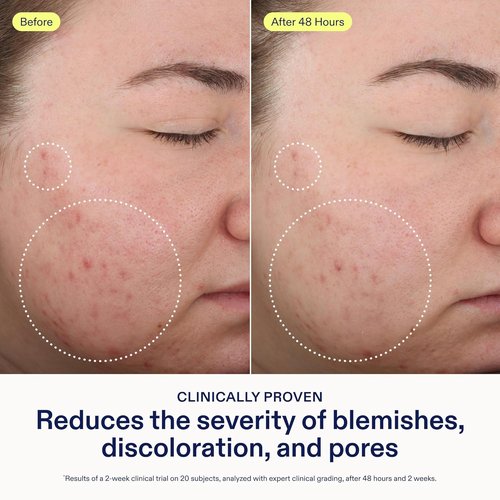 Skinfix 2% BHA Cleanser - Clears Acne Blemishes & Blackheads - 1 oz - Fragrance-Free, Vegan & Cruelty-Free