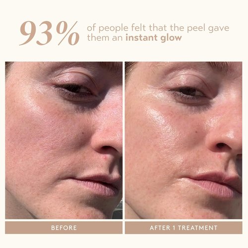 SHANI DARDEN SKIN CARE Triple Acid Peel - 2-Step Exfoliating Treatment with Mandelic & Glycolic Acids | Includes Neutralizing Mask & Brush (0.5 fl oz)