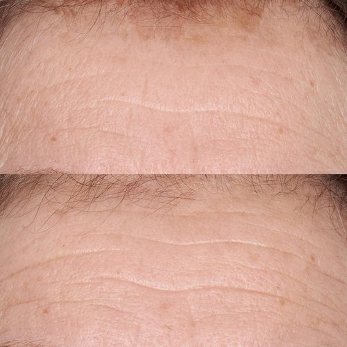 Perricone MD Smoothing Restorative Serum - Hypoallergenic Formula | 2 Fl. Oz.