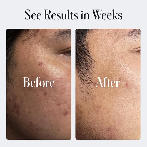 Geologie Skin Repair Moisturizer - Retinol Resurfacing Face Cream for Blemish-Prone Skin | 60 ML