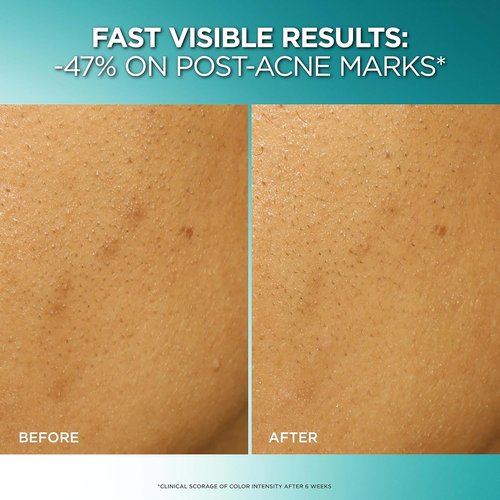 L'Oreal Paris Bright Reveal Exfoliant Peel - 25% AHA BHA PHA Face Exfoliator for Dark Spots & Renewed Skin Texture