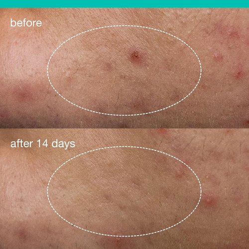 Dermalogica Deep Acne Liquid Patch - Sulfur Acne Treatment with Niacinamide | Invisible Spot Treatment - 0.5 fl oz