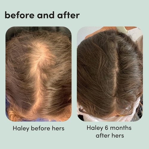 Hers Triple Threat Shampoo & Conditioner Set | 5% Minoxidil Foam for Hair Thickening - 3 Count