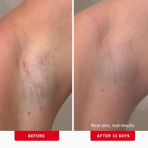 First Aid Beauty - Ingrown Hair Treatment Pads with BHA + AHA - Prevent Razor Bumps, Exfoliate Underarms & Bikini Area - 28 Compostable Pads