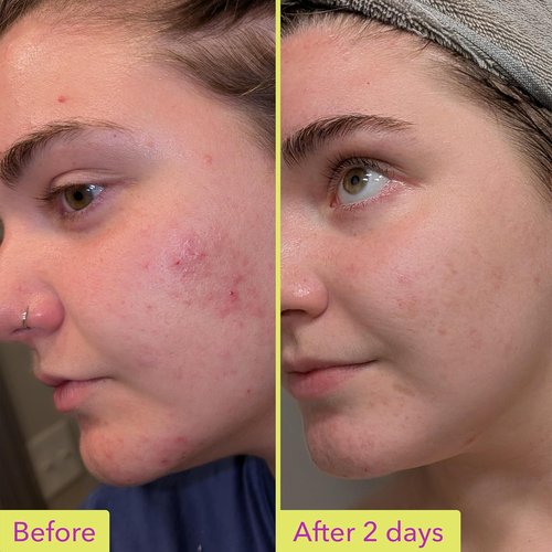 Good Molecules 10% Azelaic Acid Treatment - Soothing Formula for Redness & Uneven Tone | Brightens Dark Spots & Refines Texture | Vegan & Fragrance-Free (30ml / 1.01 fl oz.)