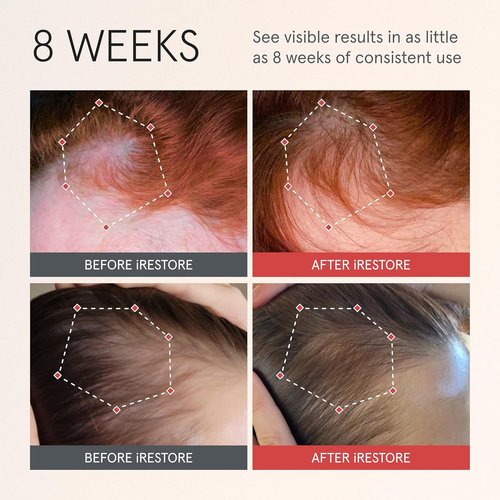 iRESTORE Scalp Serum - Hair Growth Serum for Men & Women | Boosts Regrowth with Redensyl, Capixyl & Biotin | Hydrates for Thicker, Fuller Hair - 2 Fl Oz