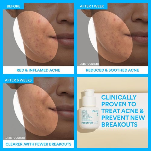 Innisfree Gentle Retinol Salicylic Acne Serum - Korean Face Treatment for Clear Skin & Blemish Control