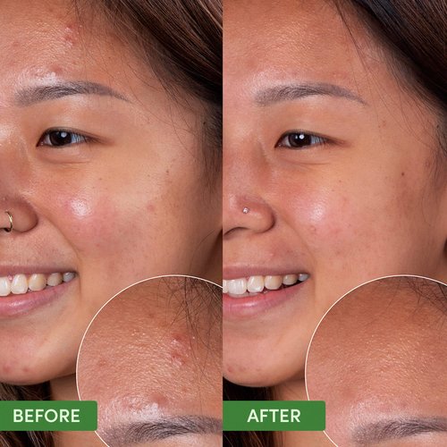 Sand & Sky Face Wash Acne Face Wash with Salicylic Acid - Oil Control Clearing Cleanser for Oily Skin, pH-Balanced Facial Cleanser with Prebiotics, Reduces Redness & Blemishes, Australian Skincare 4oz