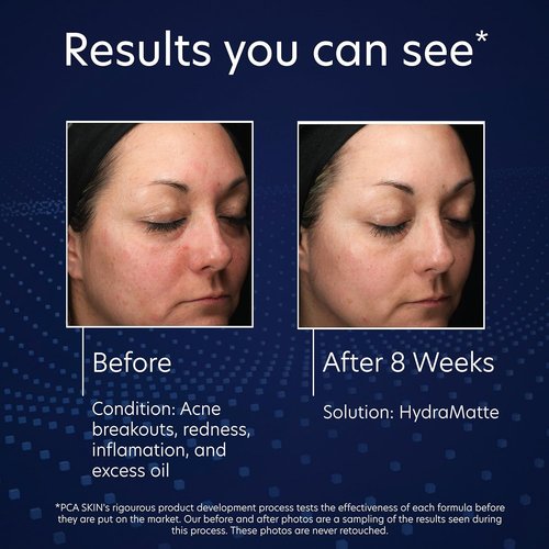 PCA SKIN HydraMatte Oil Control Moisturizer - Quick Absorbing Formula for Oily Skin | 1.8 oz Jar