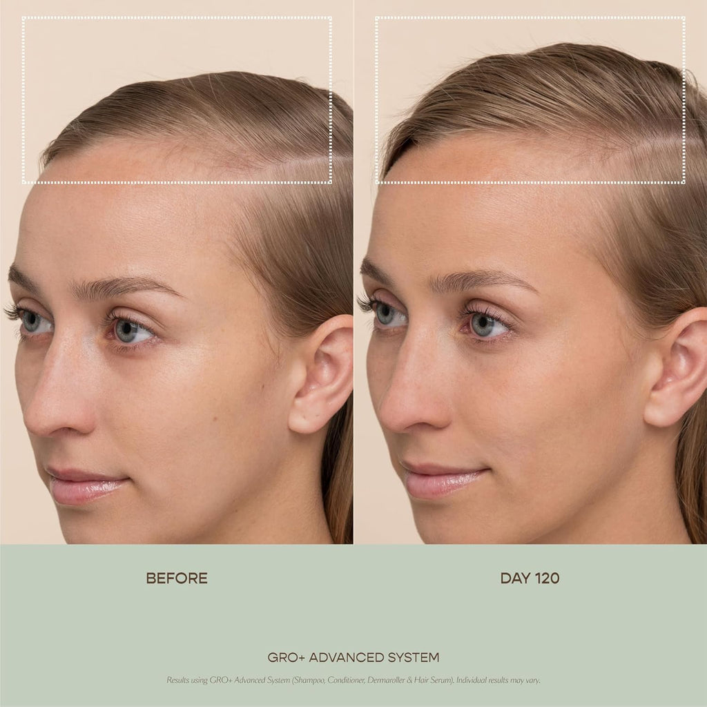 VEGAMOUR GRO+ Advanced Dermaroller - 1,200 Microneedle 0.25mm Scalp Tool | Gently Exfoliates for Maximum Coverage