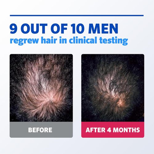 Rogaine Men’s 5% Minoxidil Foam - Clinically Proven Hair Regrowth Treatment | Unscented, 3-Month Supply (3 x 2.11 oz)