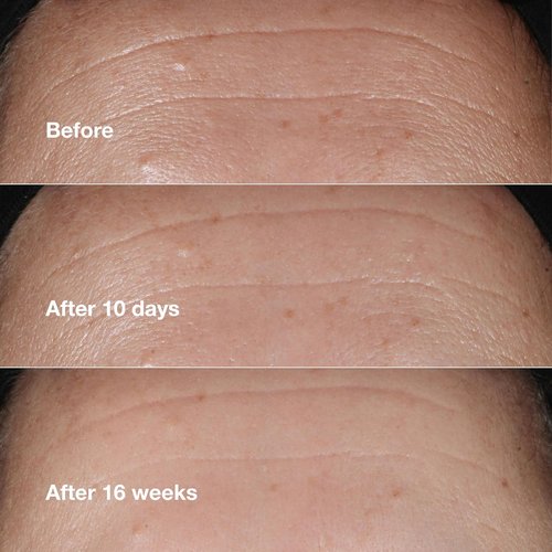 Clinique Smart Clinical Repair Anti-Aging Face Serum - Hydrating Formula with Hyaluronic Acid & Peptides