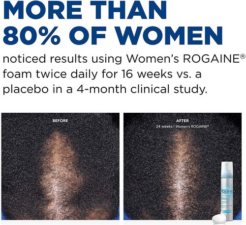 Rogaine 5% Minoxidil Foam - Once-A-Day Hair Loss Treatment for Women | Unscented, 2-Month Supply, 2.11 oz
