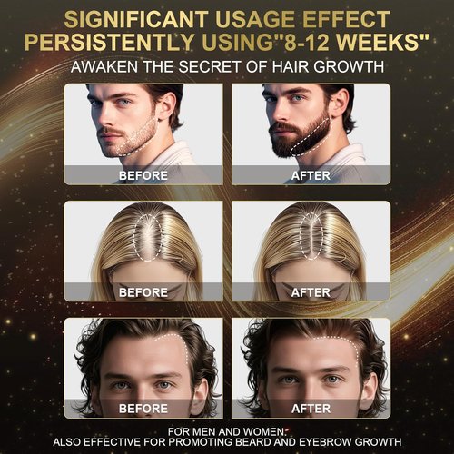 Regine Switzerland 5% Minoxidil Foam - Fast-Absorbing Hair Growth Treatment for Men & Women | 3-Month Supply (3 x 2.12 oz)