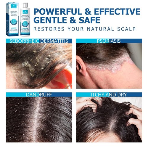 Roycederm Seborrheic Dermatitis Shampoo - Relieves Itching & Flaking for Dry Scalp Care
