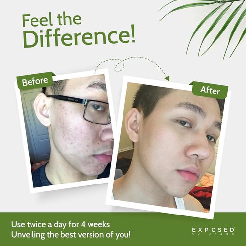 Exposed Skin Care Acne Treatment Kit - 2.5% Salicylic Acid & 3.5% Benzoyl Peroxide for Clear Skin | Natural & Cruelty-Free