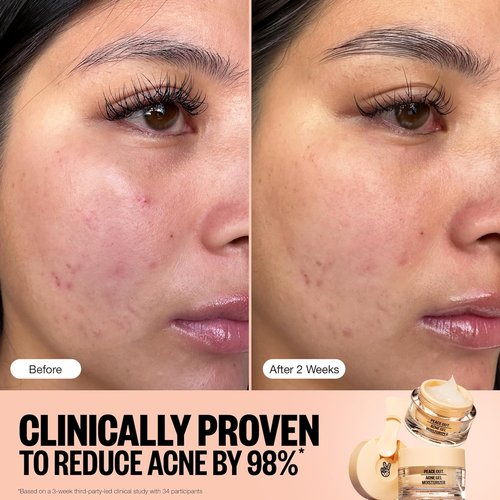 Peace Out Acne Gel Moisturizer - Oily Skin Face Cream with 2% Salicylic Acid & Niacinamide | 1.69 fl oz
