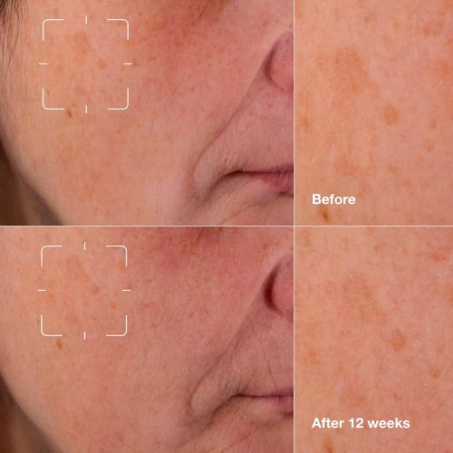 Clinique Even Better Clinical Dark Spot Clearing Serum - Brightening & Soothing for All Skin Types