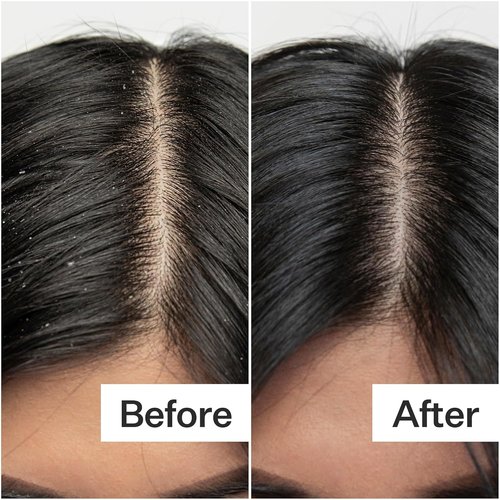 Act+ Acre Cold Processed Salicylic Acid Exfoliator - Balance & Soothe Scalp Build-Up | 2 Fl Oz