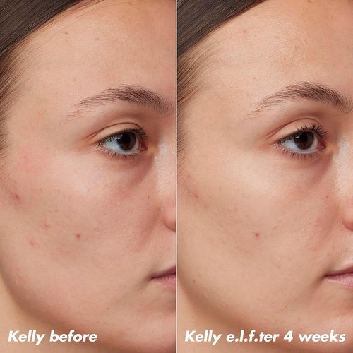 e.l.f. SKIN PLZ Clarify Facial Oil - Acne Treatment & Redness Relief with Salicylic Acid | 1 oz Vegan