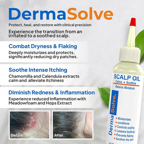 Dermasolve Scalp Oil - Flaky Scalp Relief for Psoriasis & Dandruff - 4 oz Dermatologist Approved