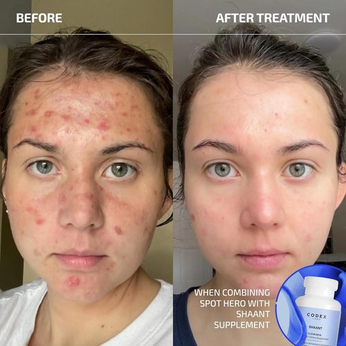 Codex Labs Shaant Spot Hero – 5% Sulfur Acne Spot Treatment | Clinically Tested for Sensitive Skin | 0.5 oz