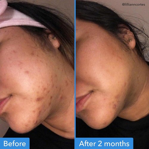 Good Molecules Discoloration Correcting Serum - Target Dark Spots & Hyperpigmentation - 1 FL Oz