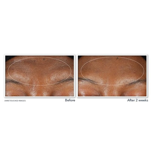 RoC Retinol Correxion Deep Wrinkle Serum - Anti-Aging Facial Cleanser with Niacinamide, 6 oz