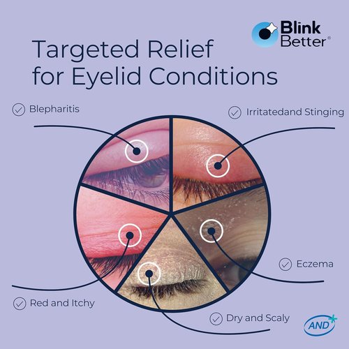 BlinkBetter BetterLids Eyelid Ointment - Deep-Moisturizing Relief for Dry, Itchy Eyelids | 0.34 oz