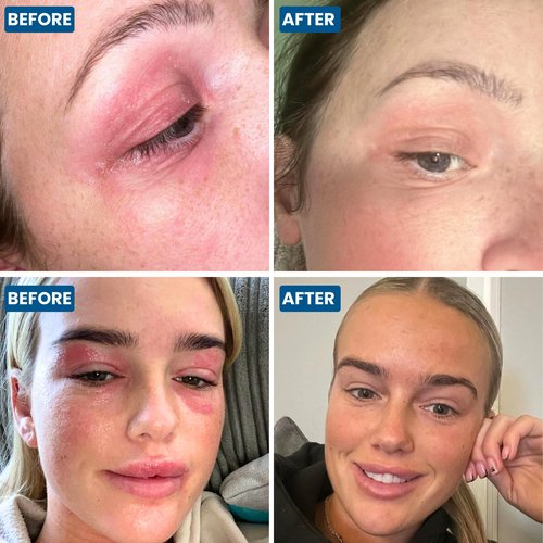 Grahams Natural Face & Eyelid Oil - For Very Dry Skin Around Eye & Face, Eczema & Perioral Dermatitis - Steroid-Free, Hypoallergenic, Non-Comedogenic - 100% Pure - with Argan & Jojoba Oil (1.69 Fl Oz)