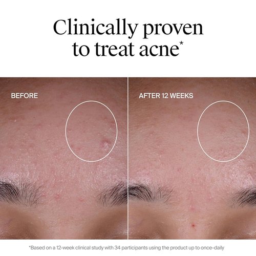Neutrogena Evenly Clear Acne Exfoliant - Multi-Acid Treatment Serum with Salicylic & Mandelic Acid | 1 fl. oz